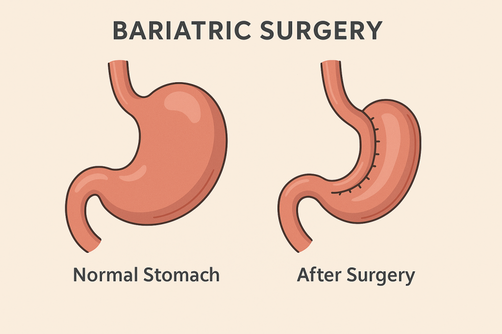 Bariatric Surgery on the Stomach
